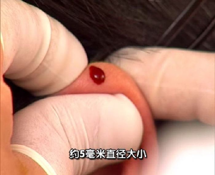 周围的耳廓,使其出血(如血自出,则可不必挤压,然后用酒精棉球吸取血滴