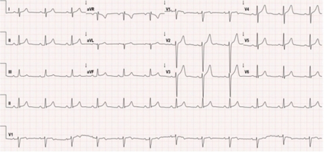 图1 心电图示窦性心律、早期复极