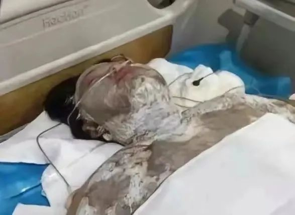 女子称被丈夫泼酒点燃后烧伤四川警方不予立案未发现证据证明系其丈夫