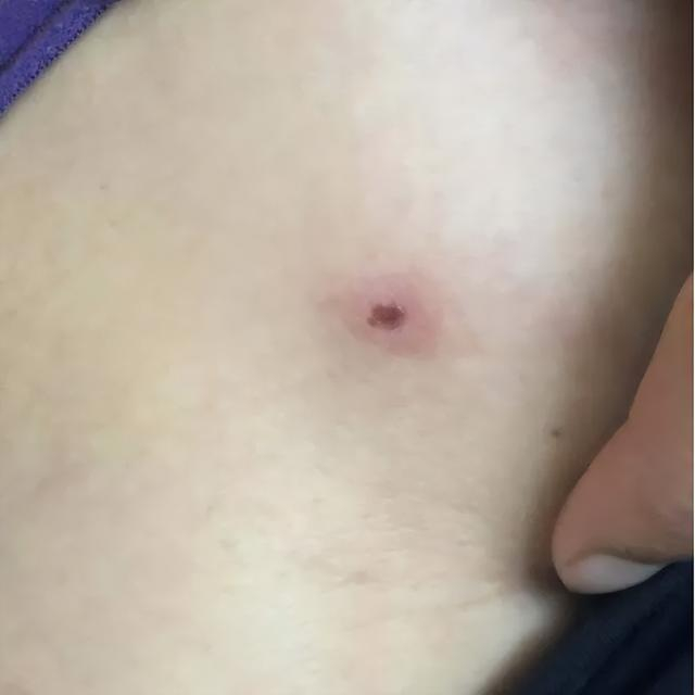 应尽量穿长衣,长裤和高帮鞋;不要赤脚下地,避免皮肤暴露,防止蜱,螨虫