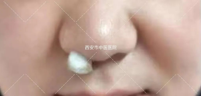 (8)针刺法,鼻内针刺法,蝶腭神经节针刺法对鼻塞,影响嗅觉的患者效果