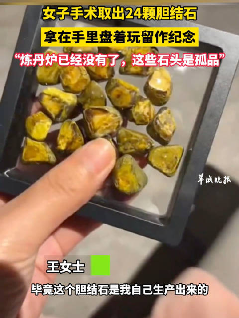 女子手术取出24颗胆结石拿在手里盘着玩留作纪念有评论认为取早了