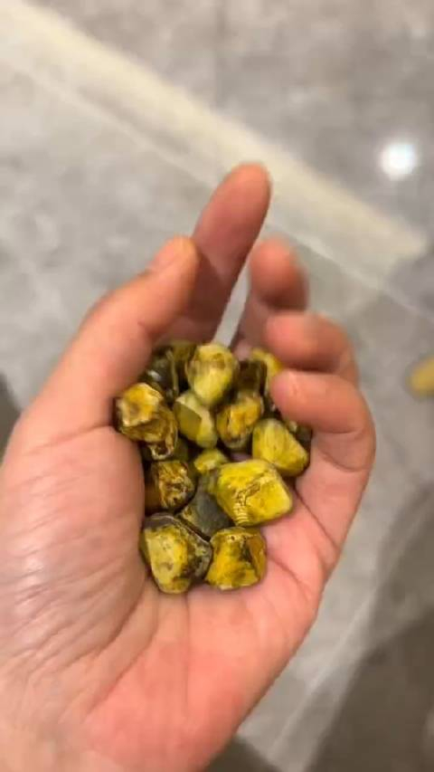 重庆29岁女子取24颗胆结石没事盘着玩网友提议制手串女子表示舍不得