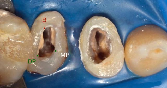 对于下切牙,30%的人有2个根管,其中常会遗漏掉舌侧根管;上颌前磨牙