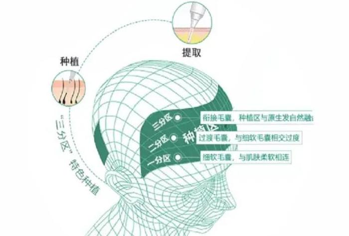 济南植发新闻(植发视频全部过程)