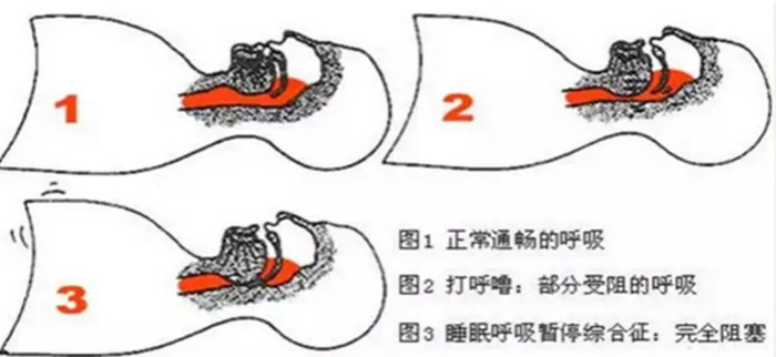 【健康咸宁】警惕"睡眠杀手"——睡眠呼吸暂停低通气综合征