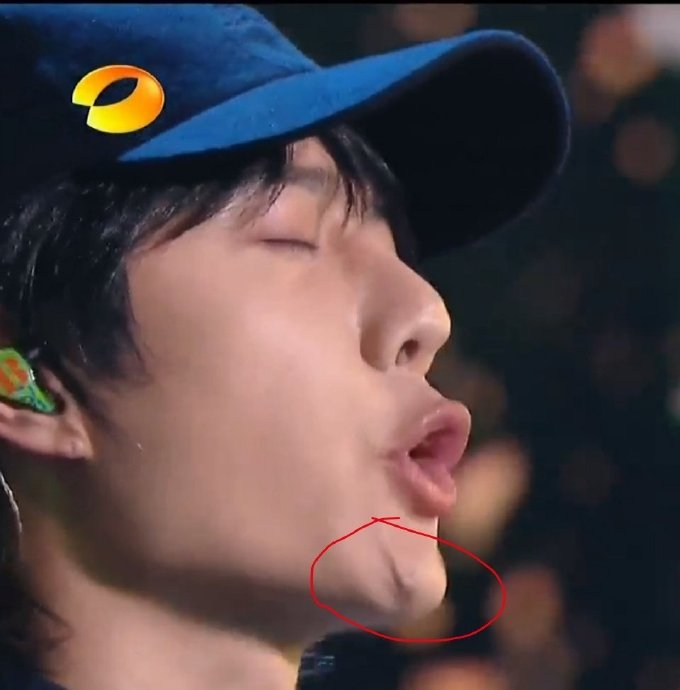 王一博下巴这块怎么了?