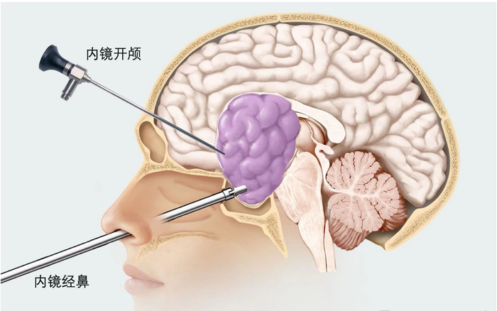 暴瘦40斤男子被查出脑中长巨瘤,"还好病人没放弃,医生没放弃!
