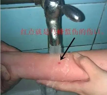 过敏性休克|马蜂|急救_新浪新闻