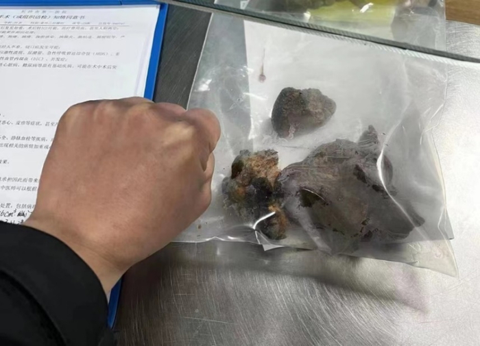 39岁男子病从口入,槟榔渣在胃内形成直径15厘米的巨大结石|胃溃疡