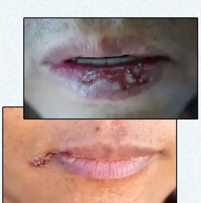 嘴唇上的皮肤很薄一旦撕掉一层及时没有破也等于是主动撤掉了一道防御