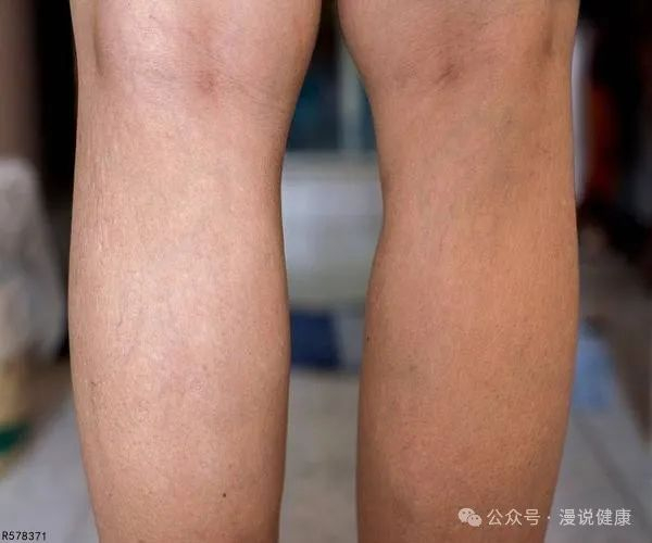 每天花个5分钟,或能轻松告别罗圈腿!|o型腿_新浪新闻