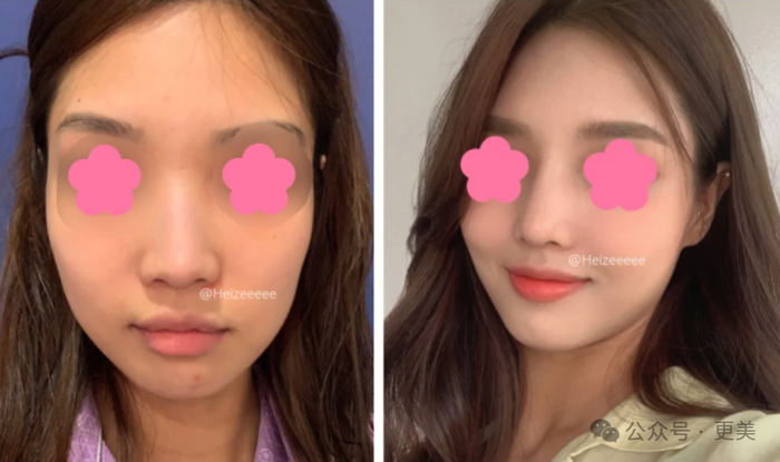 孙娜恩知道自己鼻子矮,鼻基底连带面中部凹陷,某些角度接近假性反颌