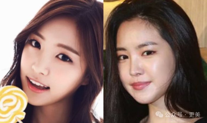 为啥垫完鼻基底后,她人中像被电熨斗烫平了一样