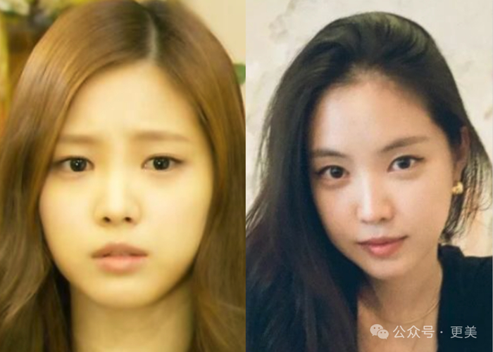 为啥垫完鼻基底后,她人中像被电熨斗烫平了一样