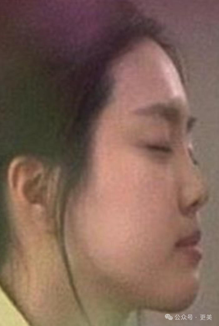 孙娜恩知道自己鼻子矮,鼻基底连带面中部凹陷,某些角度接近假性反颌