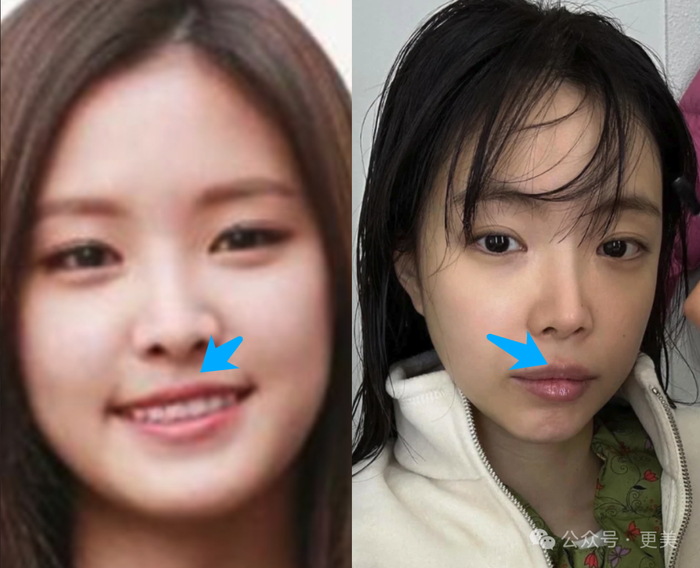 后来为了牙齿美观做了最薄最接近自然的牙贴面,效果蛮好,精致不突兀.