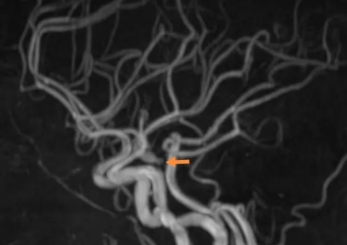 ▲术前检查，箭头所指为动脉瘤