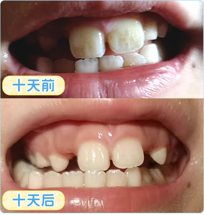 很多孩子的这个部位,从来没洗干净过|牙齿|护牙剂_新浪新闻