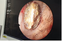 鼻腔内长石头 竟是儿时鼻出血惹的祸|鼻腔|鼻出血|鼻塞_新浪新闻