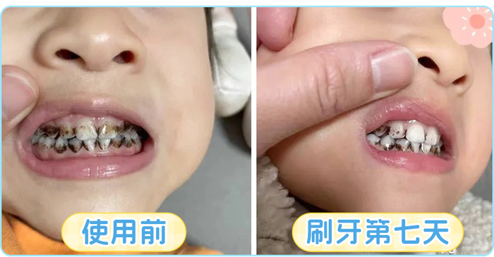 很多孩子的这个部位,从来没洗干净过|牙齿|护牙剂_新浪新闻