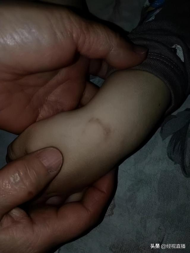 山西平遥一家长举报孩子被幼师咬伤手臂 幼师称"是吸不是咬"|山西省