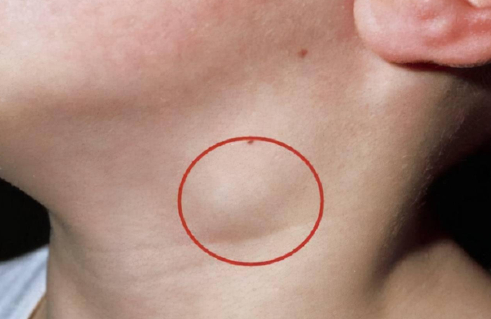 锁骨|淋巴结|身体_新浪新闻