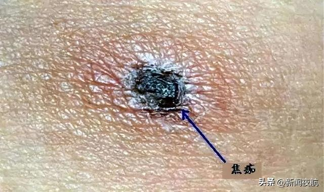 男子扫墓后就进了医院,原因竟是这样|恙虫|霉菌|感染_新浪新闻