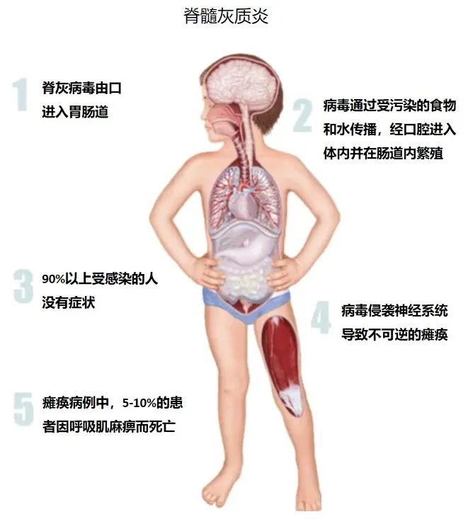 宁夏|脊灰|脊髓灰质炎_新浪新闻