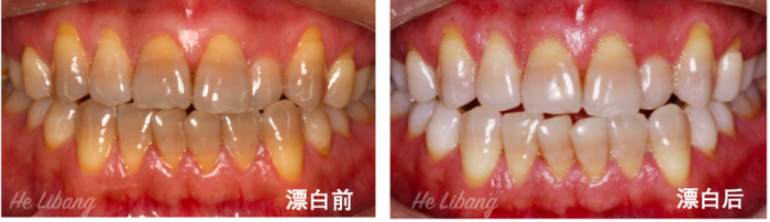 因为吃了包括土霉素在内的四环素类抗生素，长出来的“四环素牙”，从内黄到外，漂白难度比较大。图片来源：华西口腔