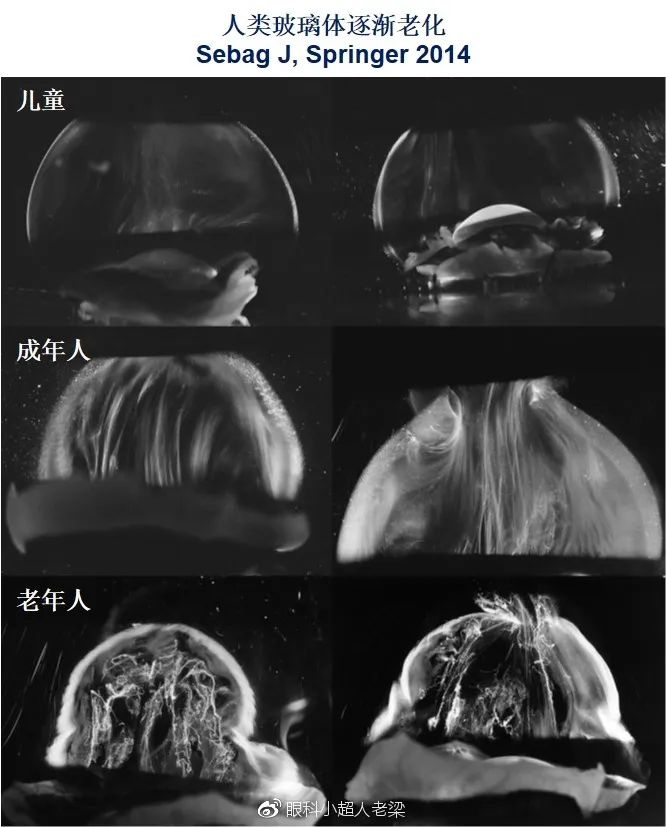 飞蚊症|视网膜|手术_新浪新闻