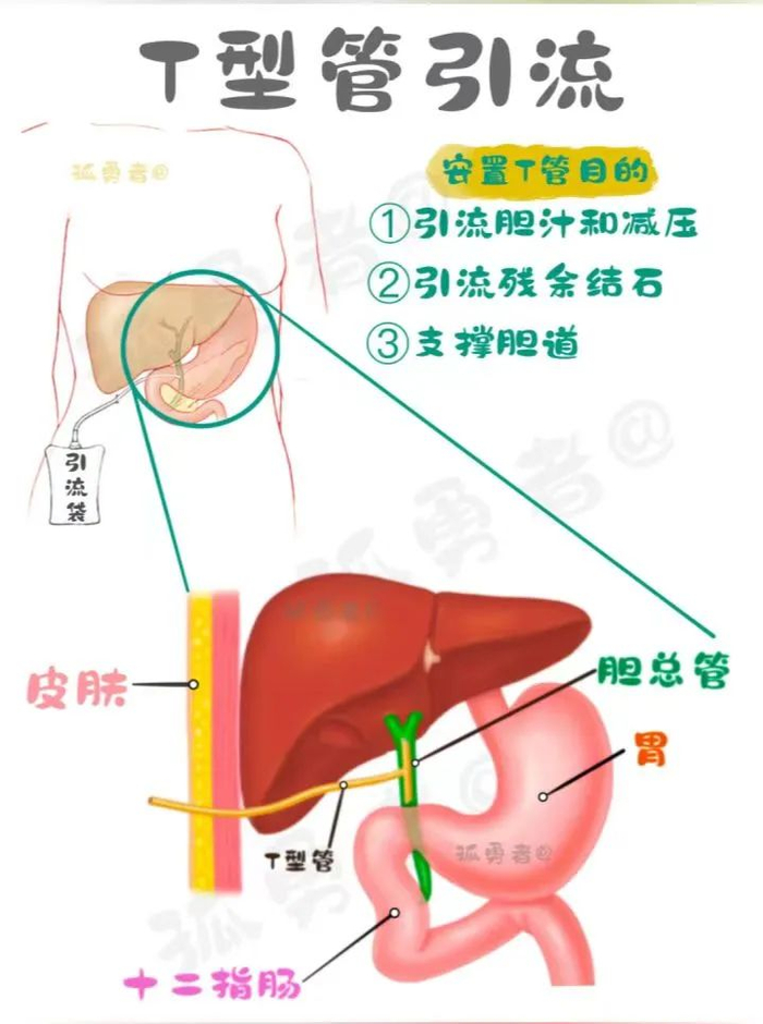 T型引流管护理技术操作并发症的预防及处理
