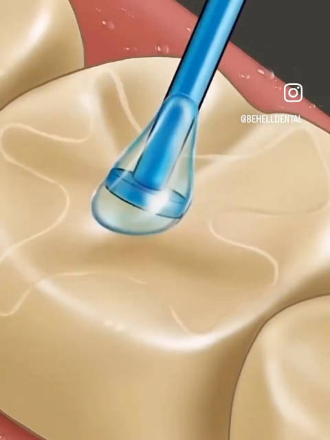 补牙动画模拟大家要爱护好牙齿