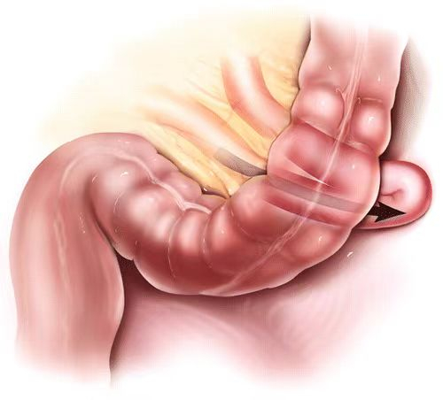 长安区医院成功实施全腹腔镜下腹内疝松解小肠复位修补术|手术|腹痛