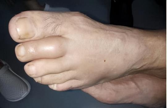 类风湿关节炎:晨僵,双手近端指间关节,掌指关节,腕关节,肘