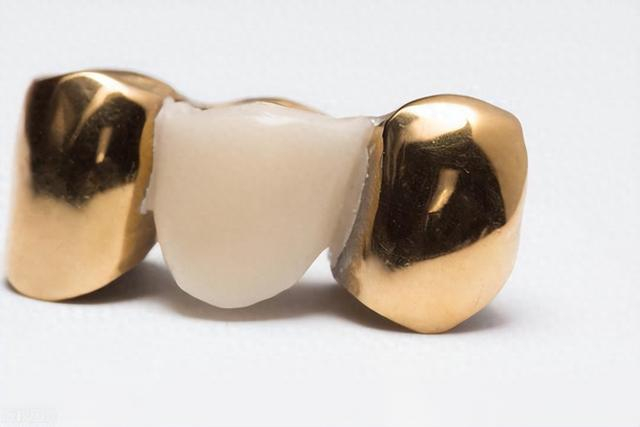 不同种类的烤瓷牙有什么区别你知道吗