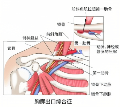 谢义松表示,诊断胸廓出口综合征需要综合考虑病史,临床表现和影像学