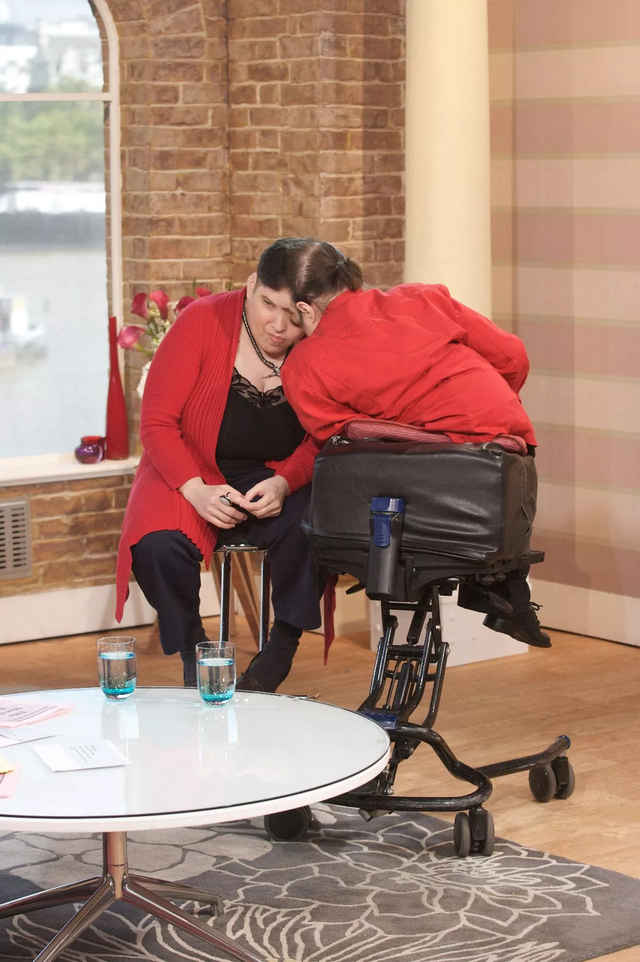 世界最年长连体双胞胎62岁去世,共享30%大脑,医生说活不过30岁|保罗