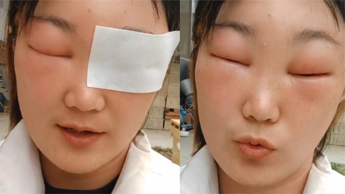 女子被蜜蜂蛰到鼻梁两眼肿成一条缝什么也看不见画面过于搞笑