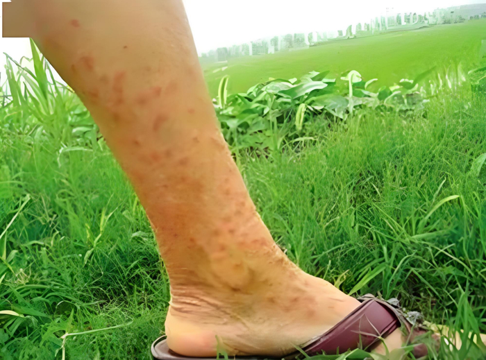 出现了发热等症状或脱离水体一个月后,应主动及时到血吸虫病防治机构