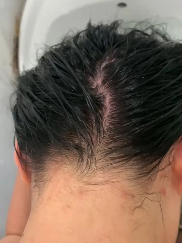 当妈后头发越来越少,可能是这个地方出了问题!很多人从没重视过