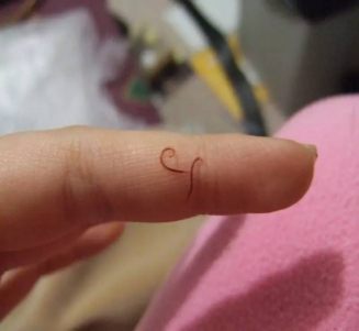 只因这些习惯"惹祸"上身→|钩虫|感染_新浪新闻