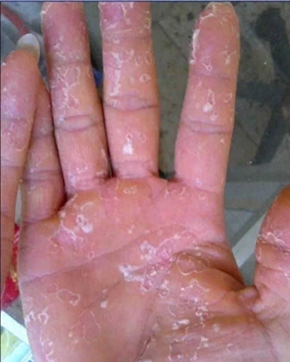 皮科妙药紫椒癣酊善治手足癣体癣