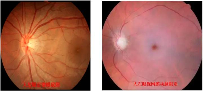 95后女孩,一觉起来右眼竟失明了!
