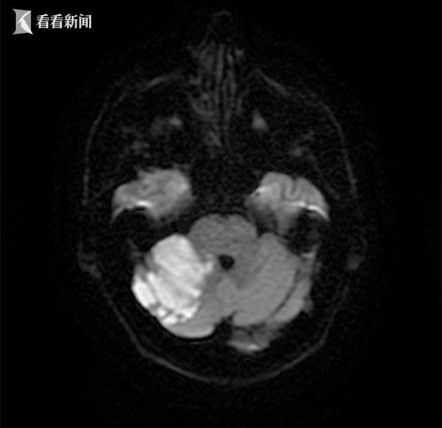 图2.头颅磁共振示右侧小脑半球大面积脑梗死