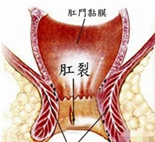 白芨膏治疗肛裂效果好