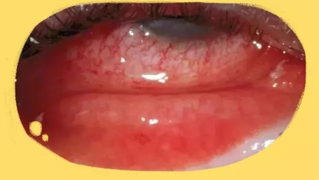 表现就是孩子眼球,内眼睑红红的,水汪汪的,觉得眼睛发痒,畏光,如下图.