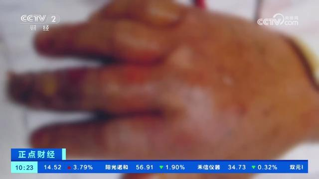 2岁幼童疑菜市场接触鱼住进icu 面临截肢风险