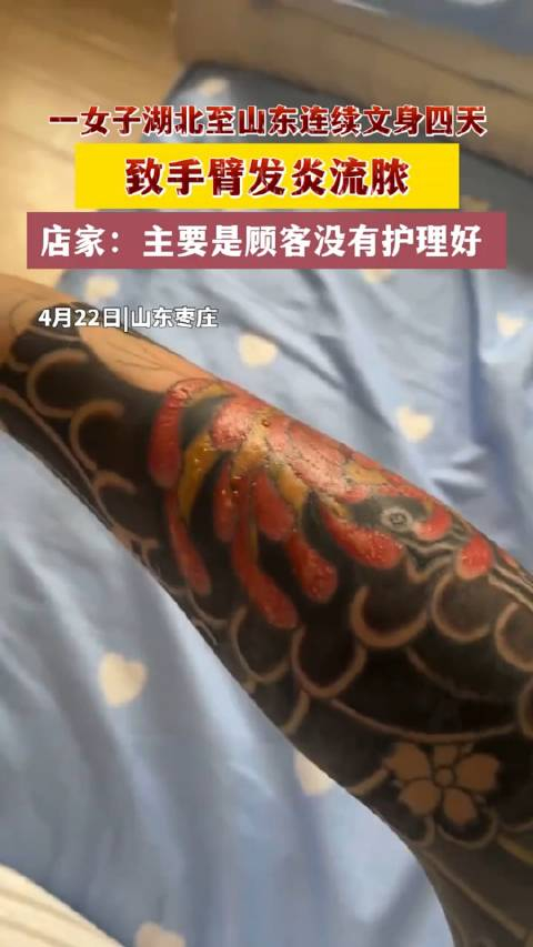 一女子经朋友介绍,专程从湖北到山东纹身四天,随后手臂流脓发炎
