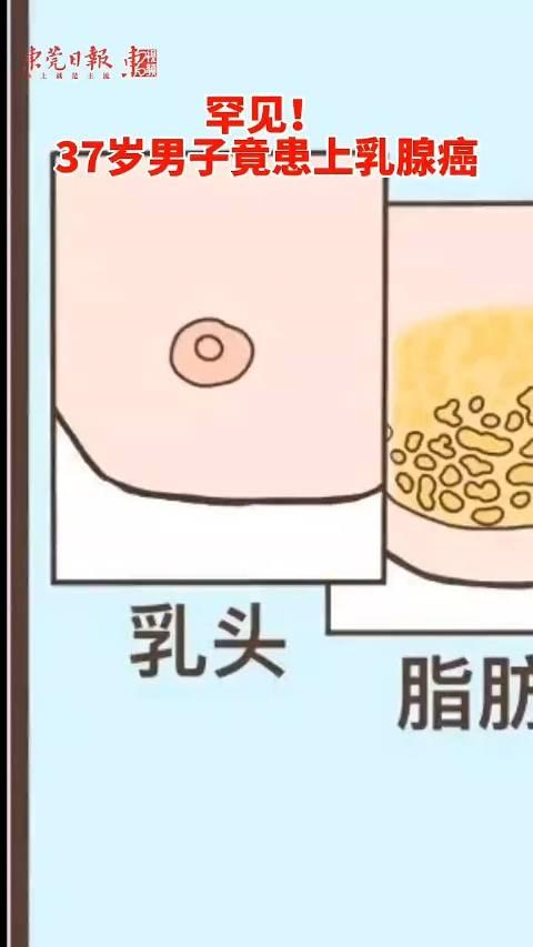 广东一男子患上乳腺癌